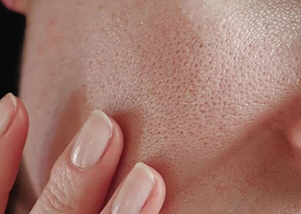how-to-get-rid-of-open-pores-blog